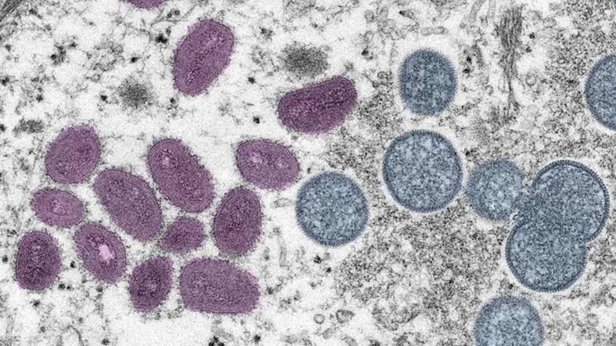 Covid, maymun çiçeği ve HIV: İtalya’da ilk kez bir kişide üç virüs birden tespit edildi
